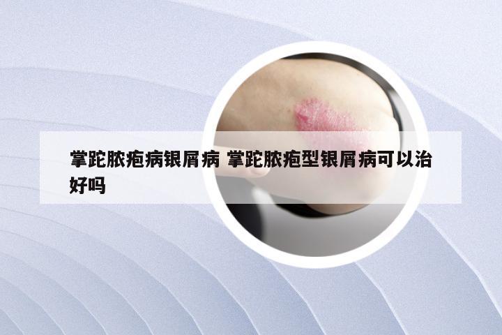掌跎脓疱病银屑病 掌跎脓疱型银屑病可以治好吗