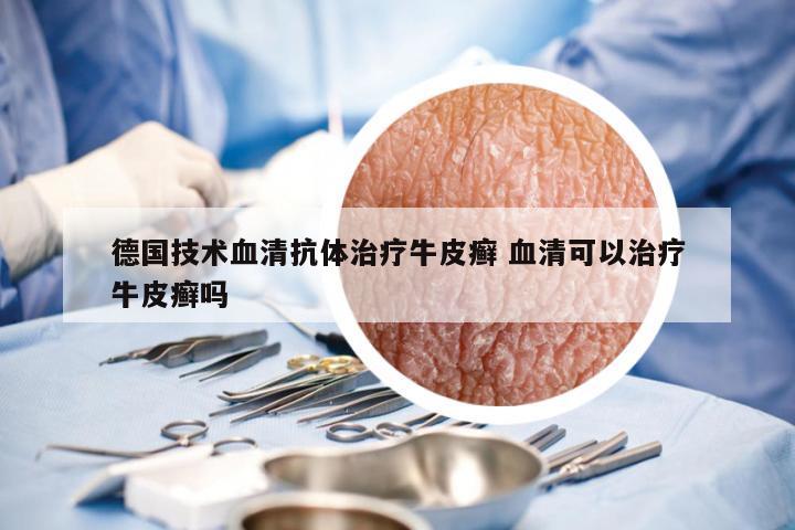 德国技术血清抗体治疗牛皮癣 血清可以治疗牛皮癣吗