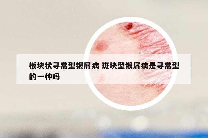 板块状寻常型银屑病 斑块型银屑病是寻常型的一种吗