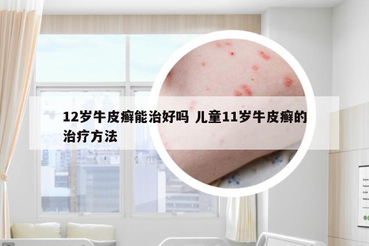 12岁牛皮癣能治好吗 儿童11岁牛皮癣的治疗方法