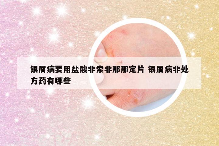 银屑病要用盐酸非索非那那定片 银屑病非处方药有哪些