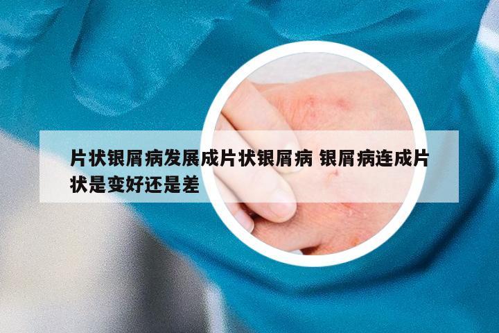 片状银屑病发展成片状银屑病 银屑病连成片状是变好还是差