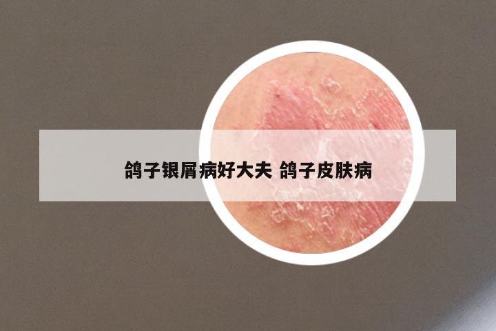 鸽子银屑病好大夫 鸽子皮肤病