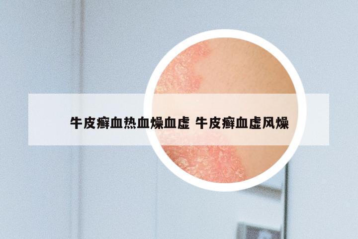 牛皮癣血热血燥血虚 牛皮癣血虚风燥