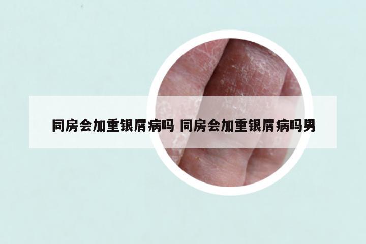同房会加重银屑病吗 同房会加重银屑病吗男
