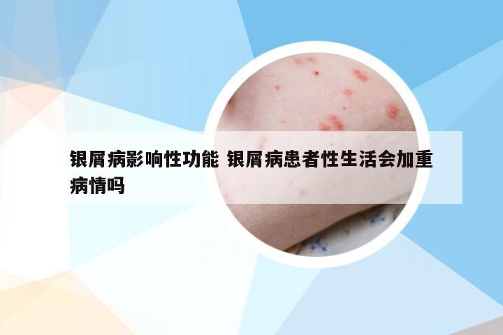 银屑病影响性功能 银屑病患者性生活会加重病情吗