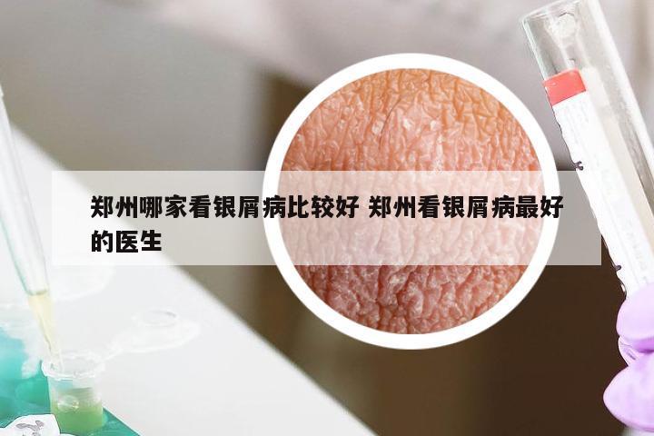 郑州哪家看银屑病比较好 郑州看银屑病最好的医生