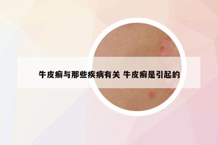 牛皮癣与那些疾病有关 牛皮癣是引起的