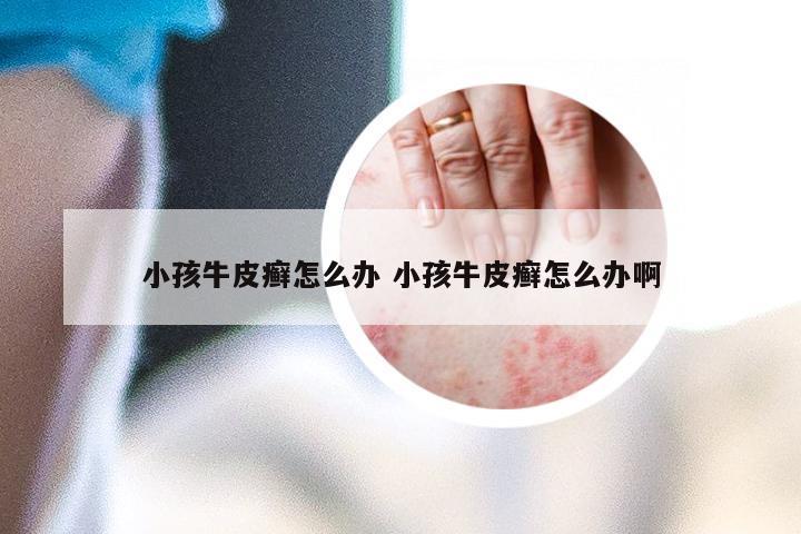 小孩牛皮癣怎么办 小孩牛皮癣怎么办啊