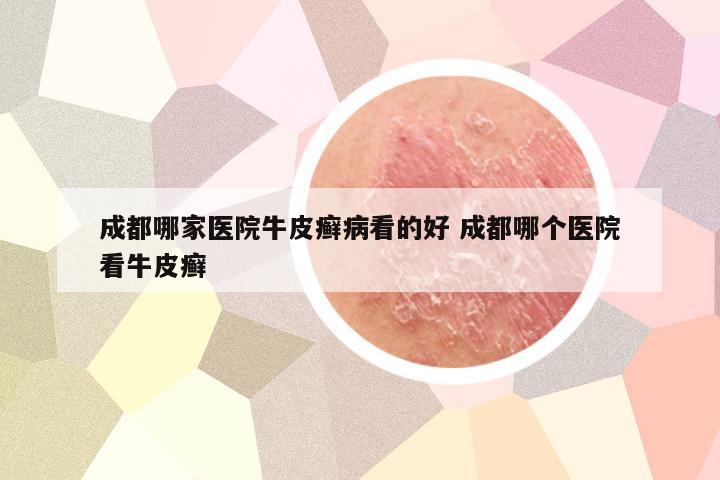 成都哪家医院牛皮癣病看的好 成都哪个医院看牛皮癣