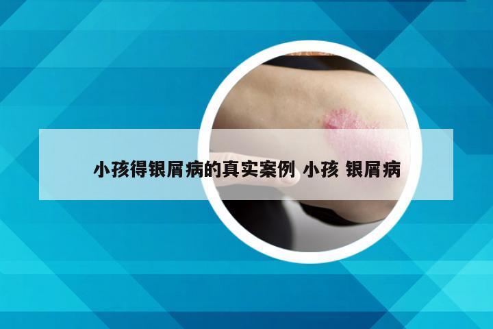 小孩得银屑病的真实案例 小孩 银屑病