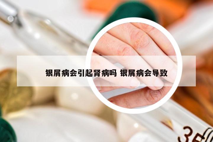 银屑病会引起肾病吗 银屑病会导致