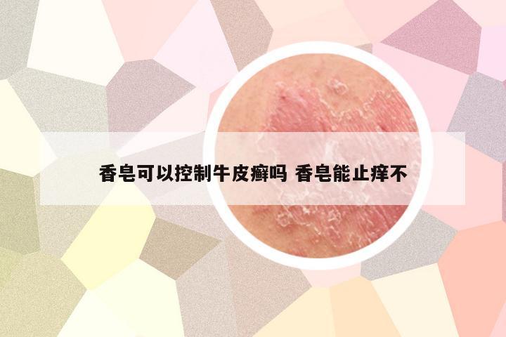 香皂可以控制牛皮癣吗 香皂能止痒不