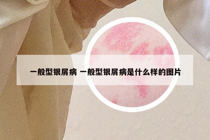 一般型银屑病 一般型银屑病是什么样的图片