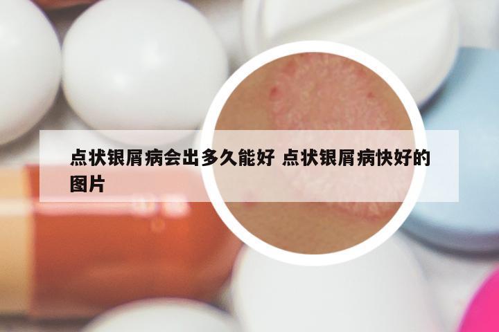 点状银屑病会出多久能好 点状银屑病快好的图片