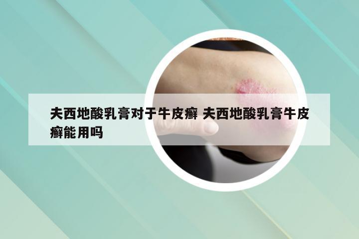 夫西地酸乳膏对于牛皮癣 夫西地酸乳膏牛皮癣能用吗