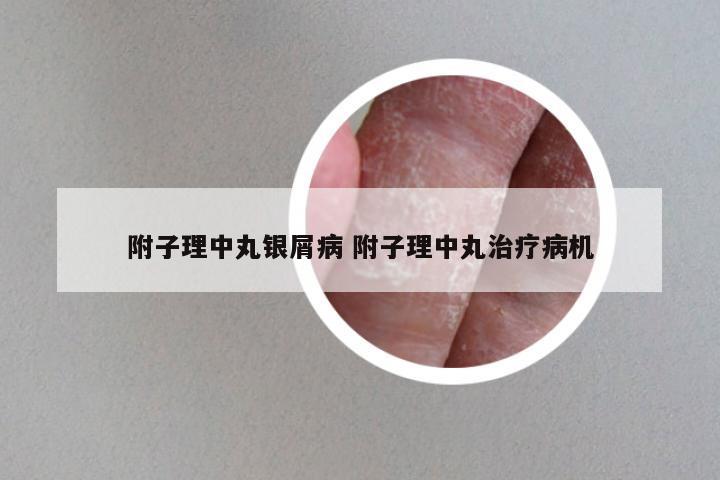 附子理中丸银屑病 附子理中丸治疗病机