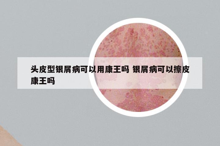 头皮型银屑病可以用康王吗 银屑病可以擦皮康王吗