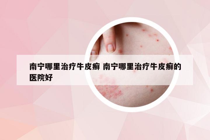 南宁哪里治疗牛皮癣 南宁哪里治疗牛皮癣的医院好