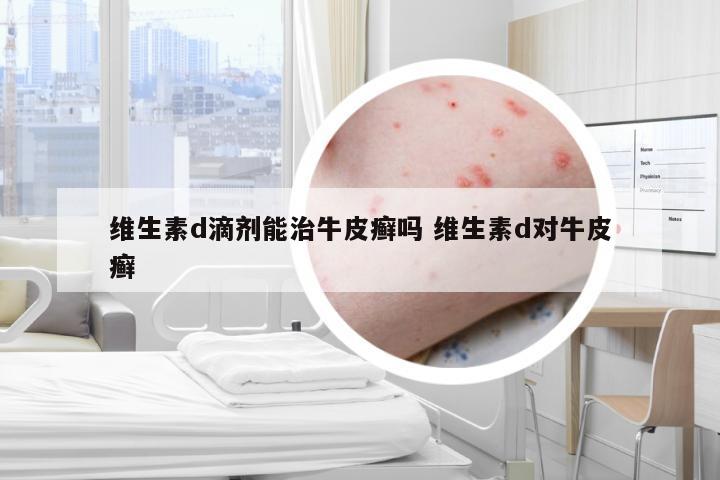 维生素d滴剂能治牛皮癣吗 维生素d对牛皮癣