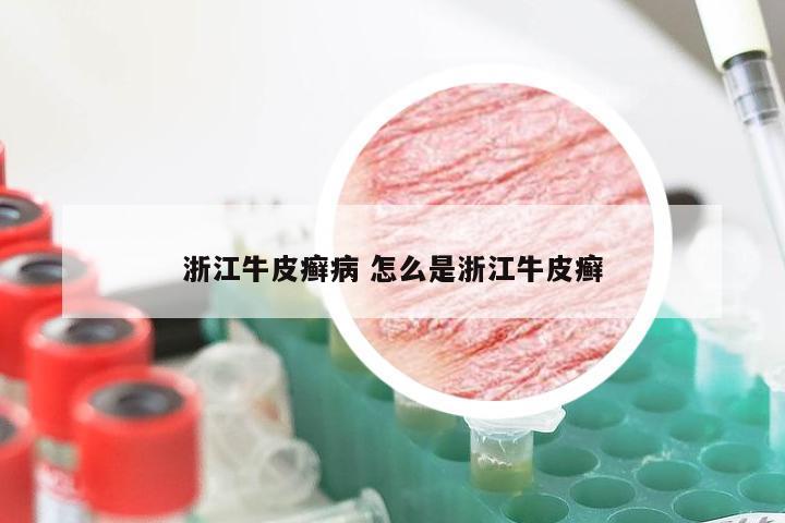 浙江牛皮癣病 怎么是浙江牛皮癣
