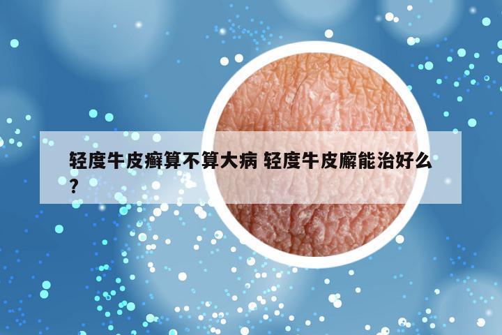 轻度牛皮癣算不算大病 轻度牛皮廨能治好么?