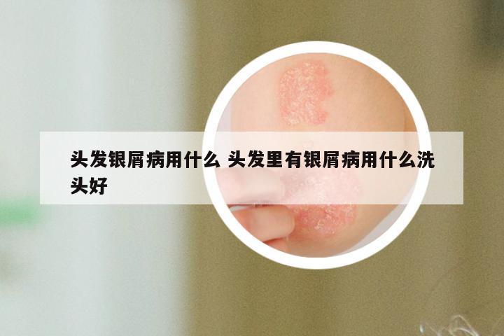 头发银屑病用什么 头发里有银屑病用什么洗头好