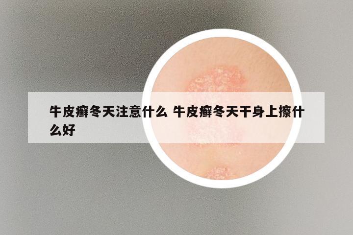 牛皮癣冬天注意什么 牛皮癣冬天干身上擦什么好