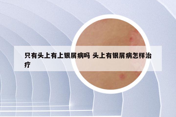 只有头上有上银屑病吗 头上有银屑病怎样治疗