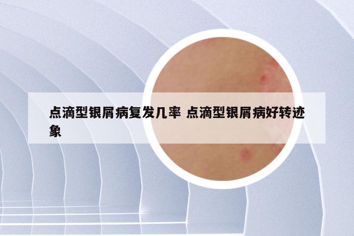 点滴型银屑病复发几率 点滴型银屑病好转迹象