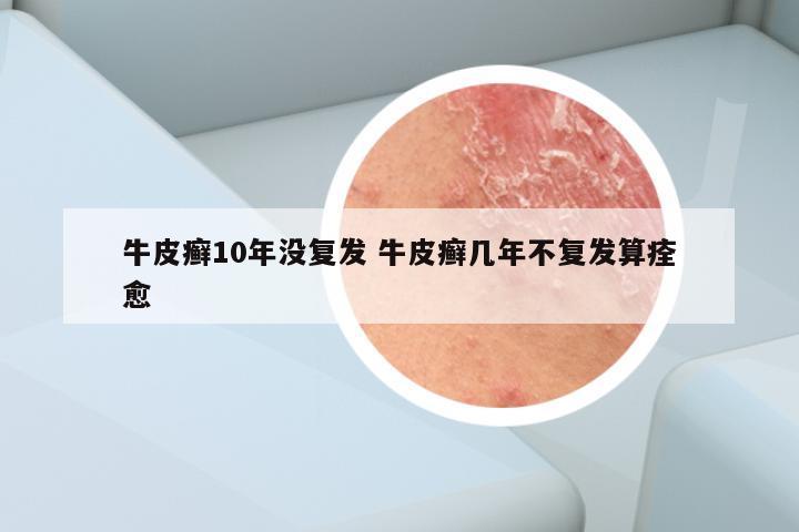 牛皮癣10年没复发 牛皮癣几年不复发算痊愈