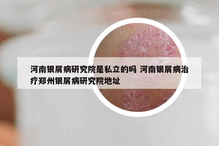 河南银屑病研究院是私立的吗 河南银屑病治疗郑州银屑病研究院地址