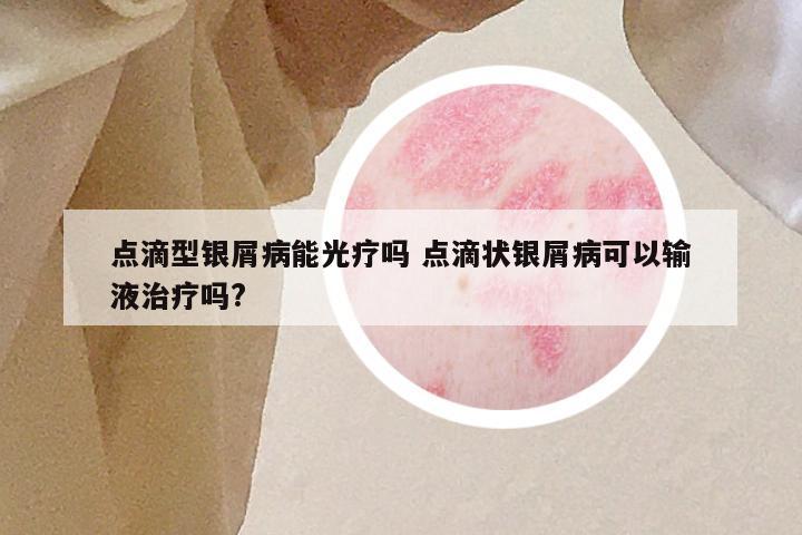 点滴型银屑病能光疗吗 点滴状银屑病可以输液治疗吗?