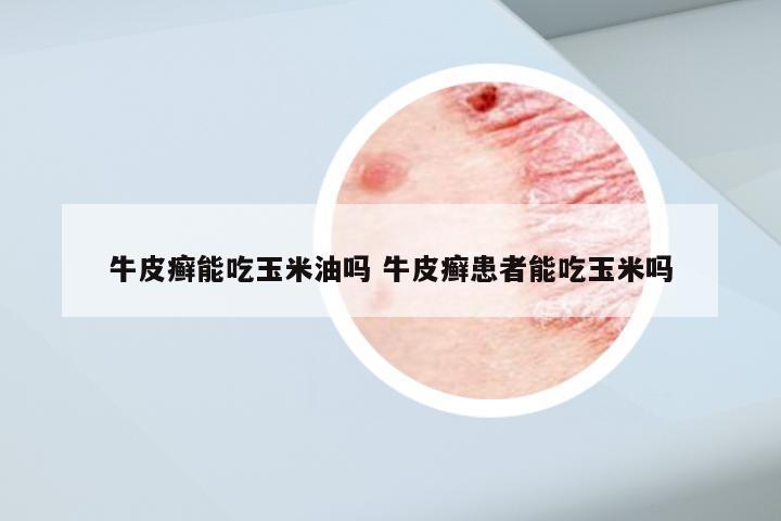 牛皮癣能吃玉米油吗 牛皮癣患者能吃玉米吗