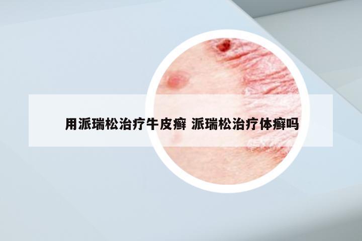 用派瑞松治疗牛皮癣 派瑞松治疗体癣吗