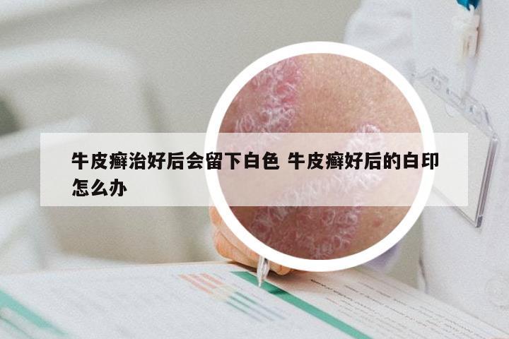 牛皮癣治好后会留下白色 牛皮癣好后的白印怎么办