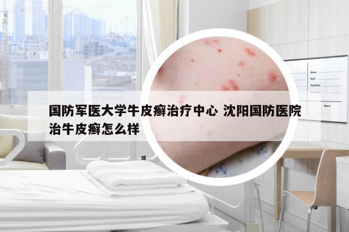 国防军医大学牛皮癣治疗中心 沈阳国防医院治牛皮癣怎么样
