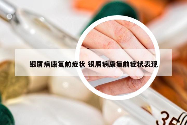 银屑病康复前症状 银屑病康复前症状表现