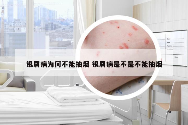 银屑病为何不能抽烟 银屑病是不是不能抽烟
