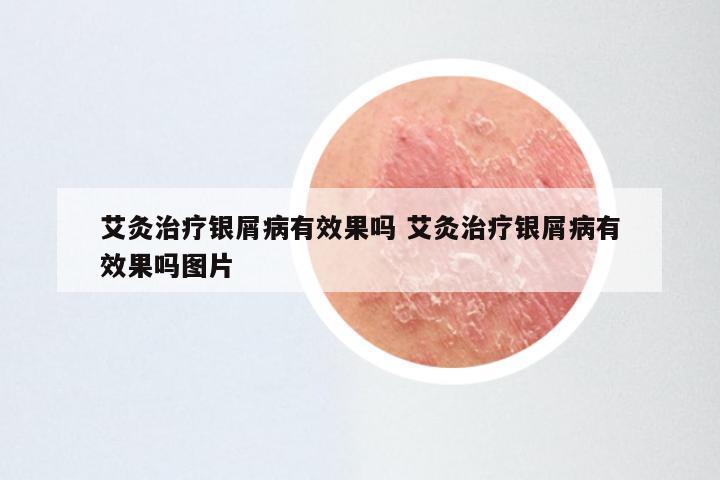 艾灸治疗银屑病有效果吗 艾灸治疗银屑病有效果吗图片