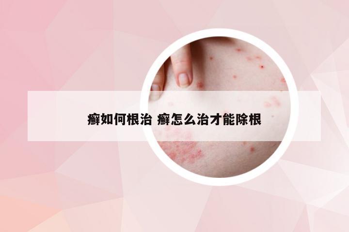 癣如何根治 癣怎么治才能除根