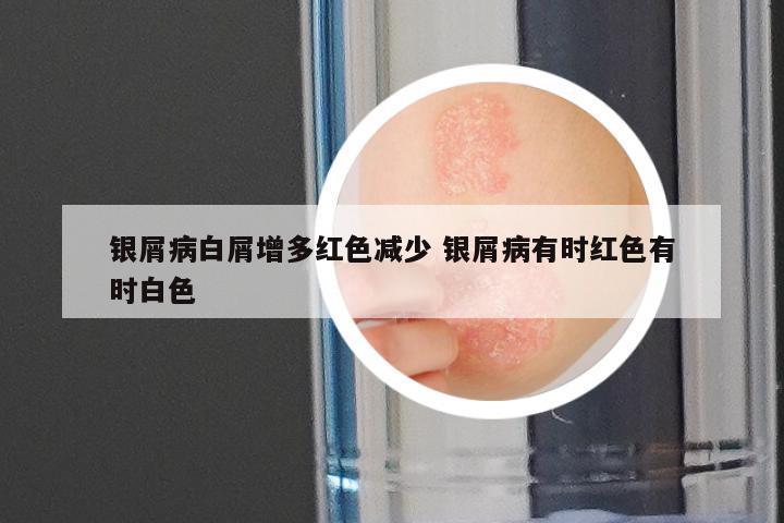 银屑病白屑增多红色减少 银屑病有时红色有时白色