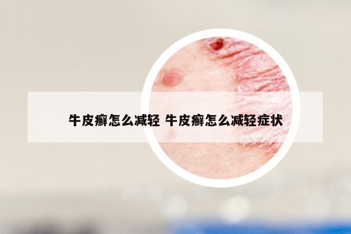 牛皮癣怎么减轻 牛皮癣怎么减轻症状