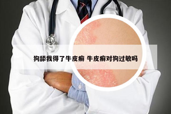 狗舔我得了牛皮癣 牛皮癣对狗过敏吗