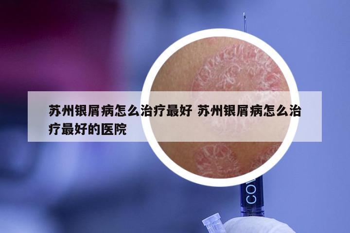 苏州银屑病怎么治疗最好 苏州银屑病怎么治疗最好的医院