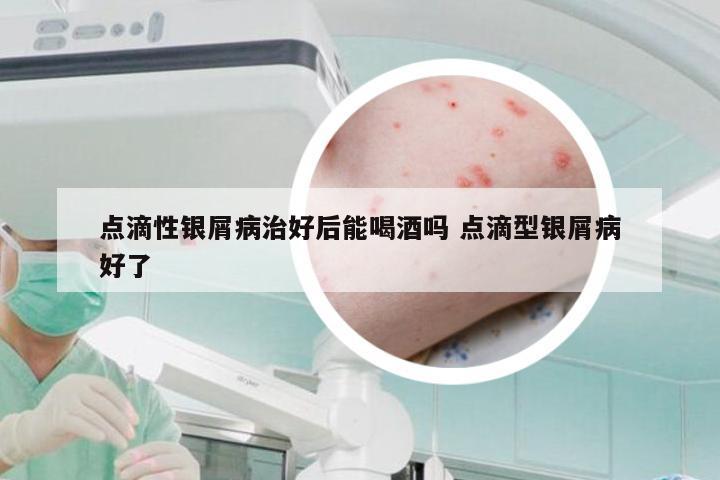 点滴性银屑病治好后能喝酒吗 点滴型银屑病好了