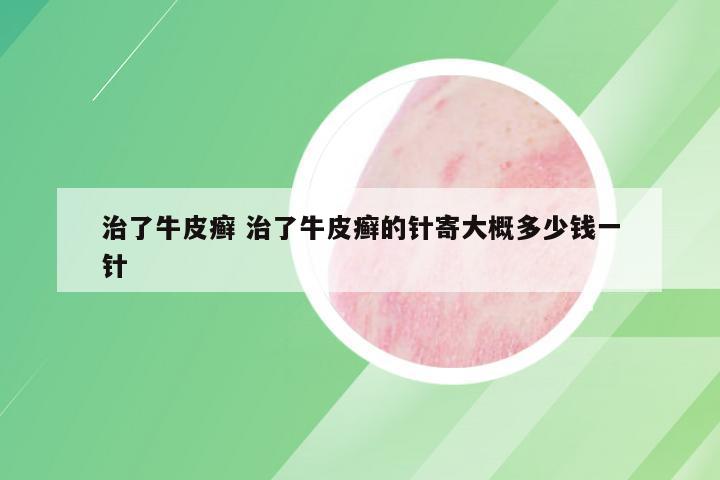 治了牛皮癣 治了牛皮癣的针寄大概多少钱一针