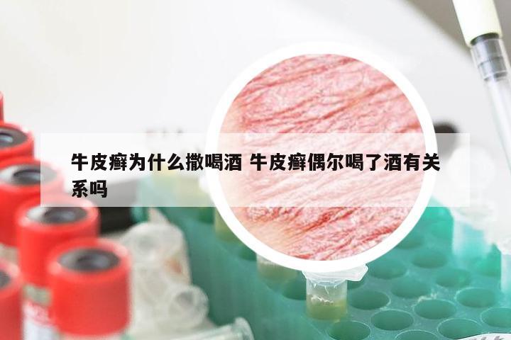牛皮癣为什么撒喝酒 牛皮癣偶尔喝了酒有关系吗