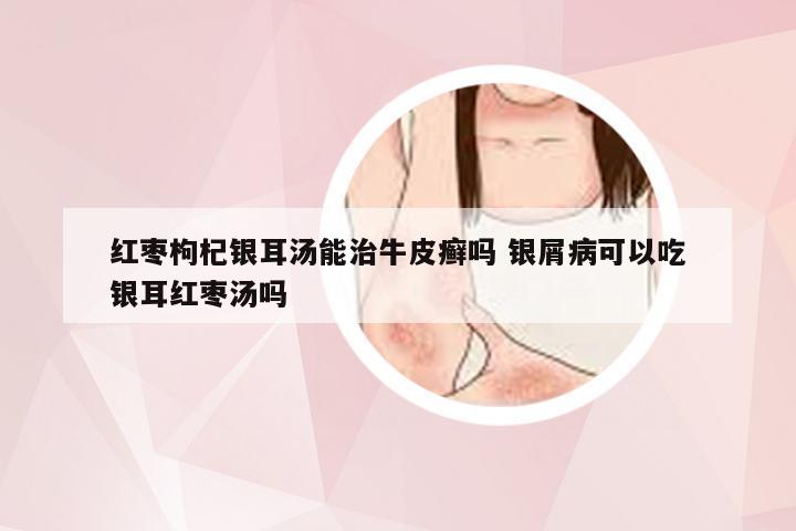 红枣枸杞银耳汤能治牛皮癣吗 银屑病可以吃银耳红枣汤吗