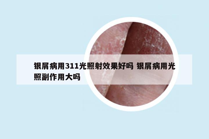 银屑病用311光照射效果好吗 银屑病用光照副作用大吗